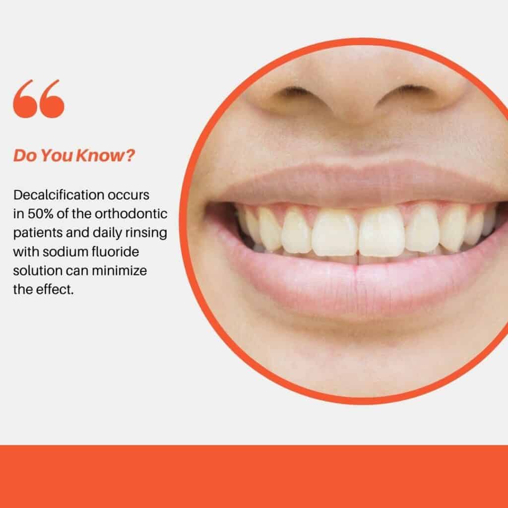 15 Reasons Not To Get Braces Genuine Side Effects Explained