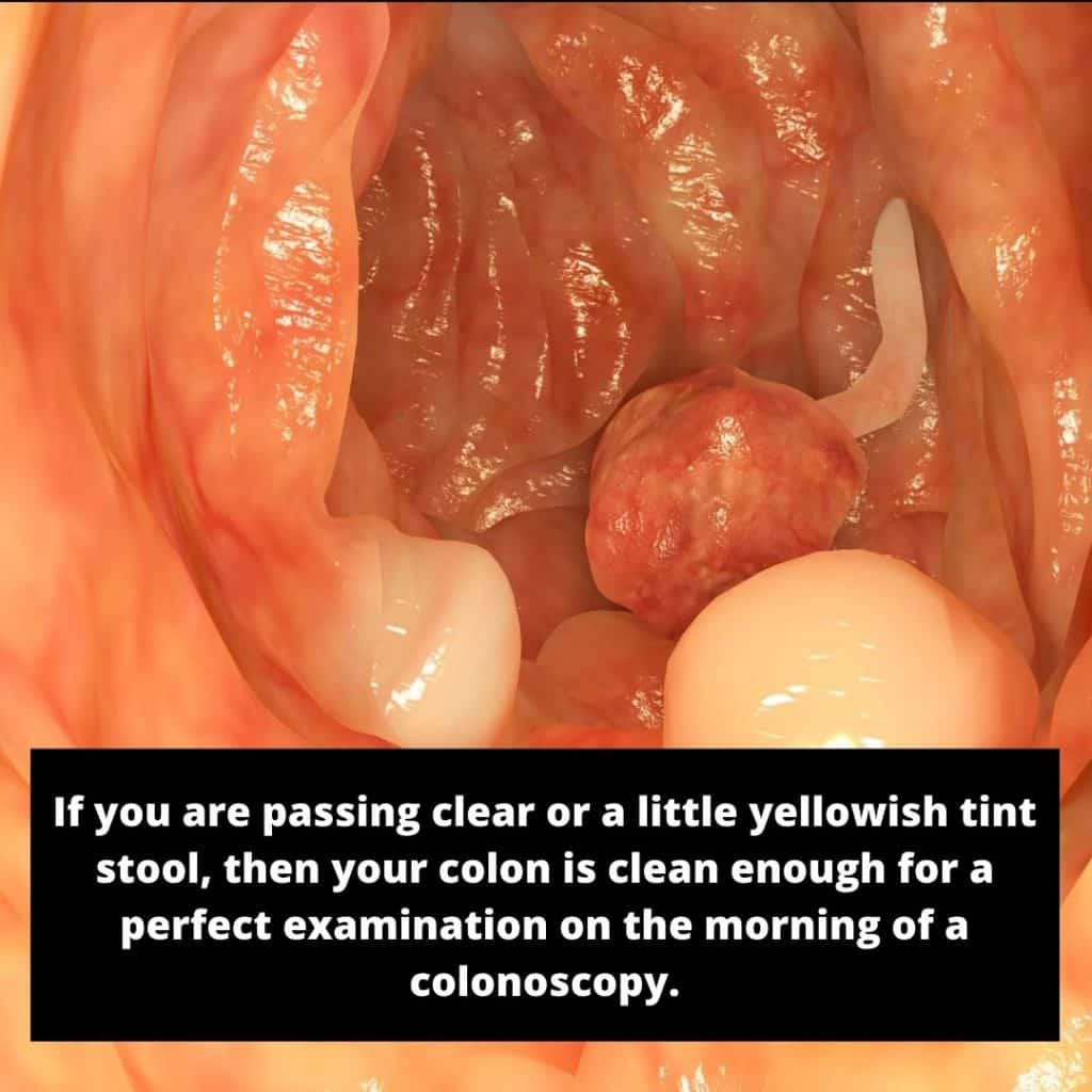 How Clear Should Stool Be on The Morning of Colonoscopy?