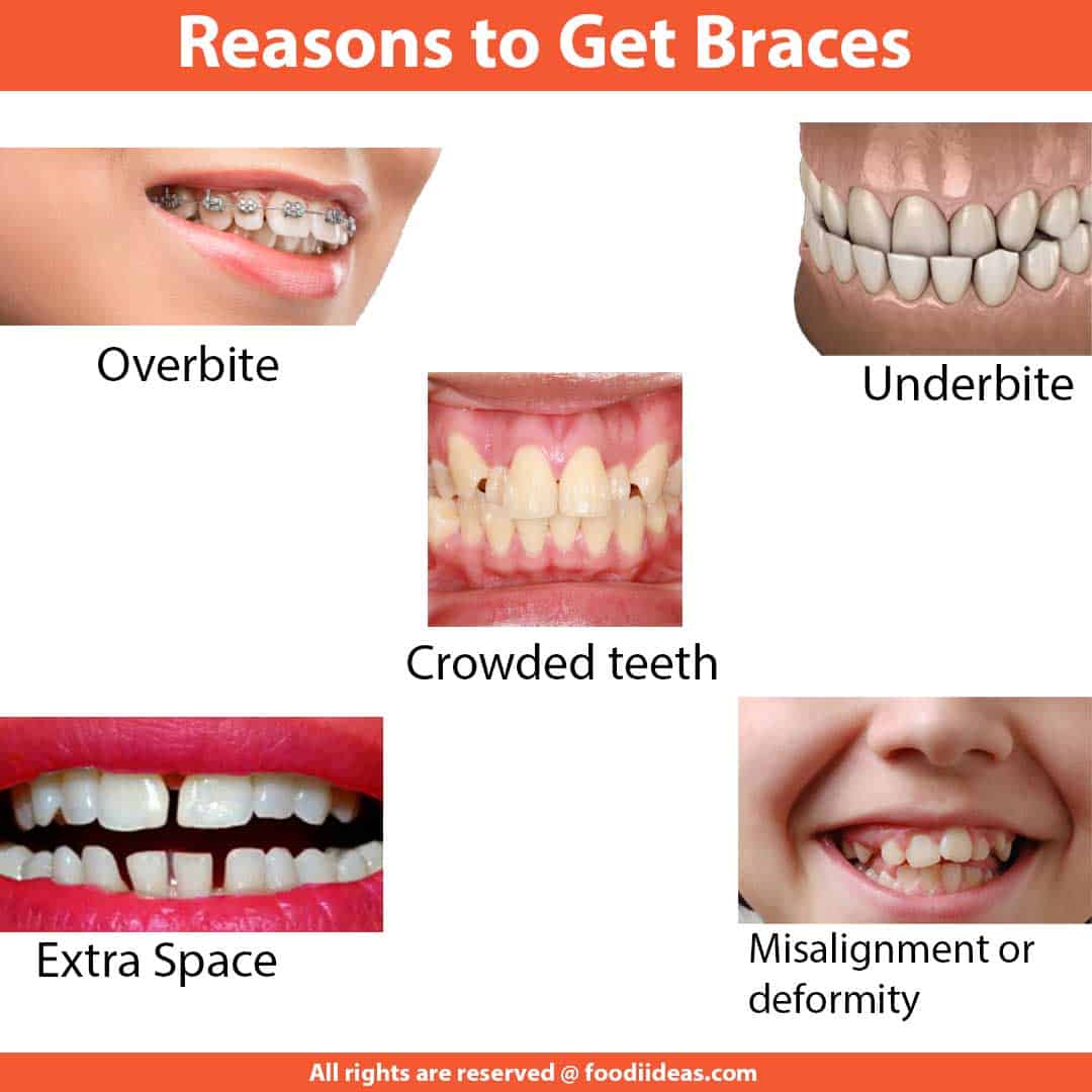 Why Are Braces Important for People with Deformed Teeth?