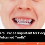 why braces are important for people with crooked teeth